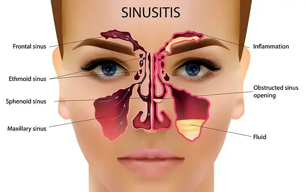 2-Sinusitis-ad6a6773-f21d-4c40-9f3b-92f887c30b00.webp