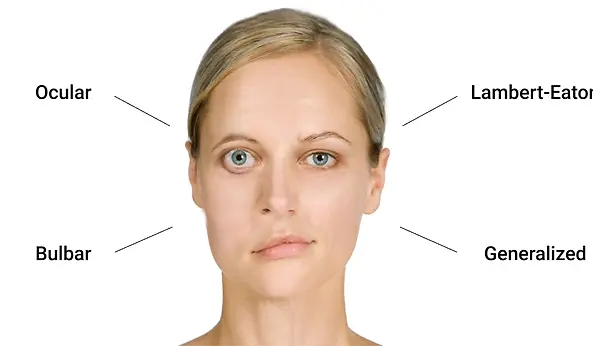2-Symptoms-and-causes-of-myasthenia-gravis.webp