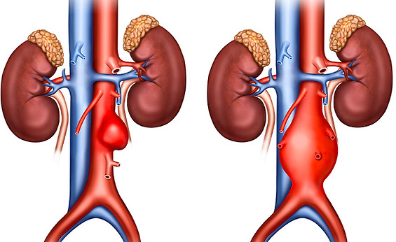 933-Anévrisme-aorte-abdominale.jpg