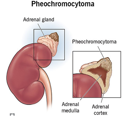 23373-pheochromocytoma.jpg