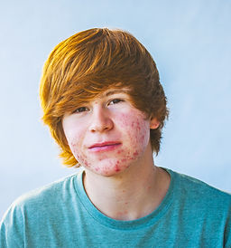 acne .jpeg