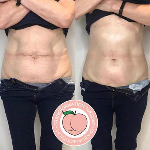 Tummy Sculp & Skin Tightening Results Glasgow
