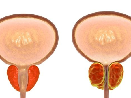 Especialista fala sobre os procedimentos que melhoram a Hiperplasia Prostática Benigna