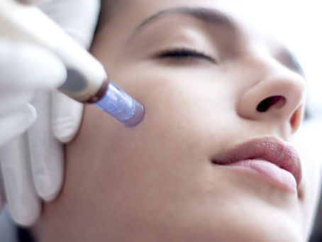Conoce los beneficios del "microneedling" (MesoPen) en Cicatrices por Acné, EstrÃas y Reju