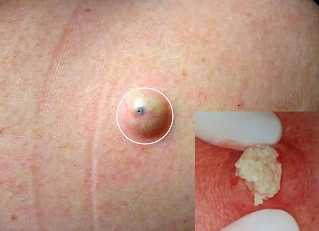 Resultado de imagen para quistes epidermoides