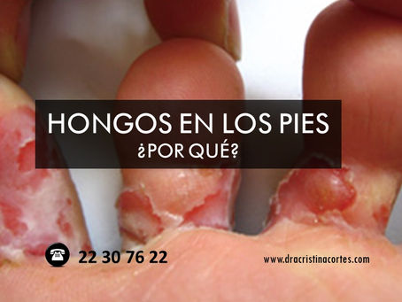 ¿Por qué te salen hongos en los pies? ¿Cómo prevenirlo?