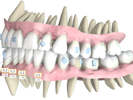Clear Aligner Treatment Planning: Why Cases Fall Apart After a Perfect Digital Setup