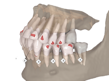 Invisalign treatment planning