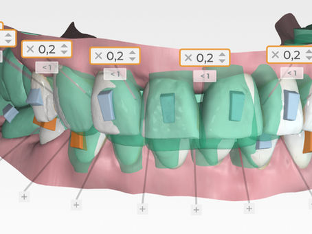 How staging and treatment preferences improve predictability in clear aligner treatment planning