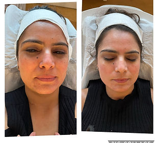 before and after facial