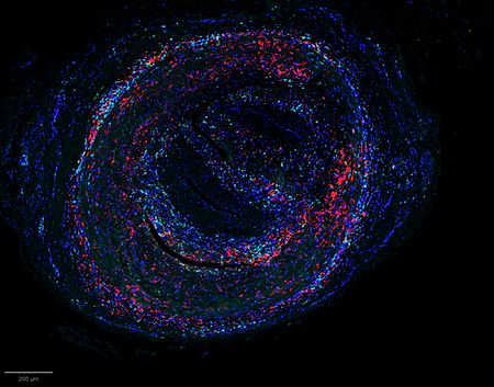 Coupe d'artère temporale en immunofluorescence au cours de l'artérite à cellules géantes : cellules immunitaires infiltrant la paroi