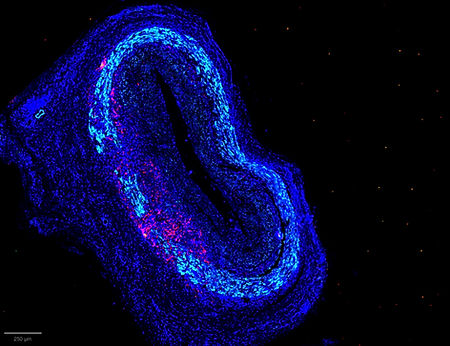 Biopsie d'artère temporale en imagerie multiplexée