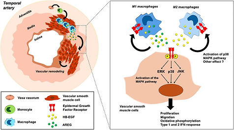 Schéma : les macrophages de la paroi artérielle libèrent l'amphiréguline et l'HB-EGF, qui activent l'EGFR des cellules musculaires lisses et favorisent le remodelage vasculaire. Source : Chevalier et al., bioRxiv 2024 (CC BY-NC-ND 4.0)