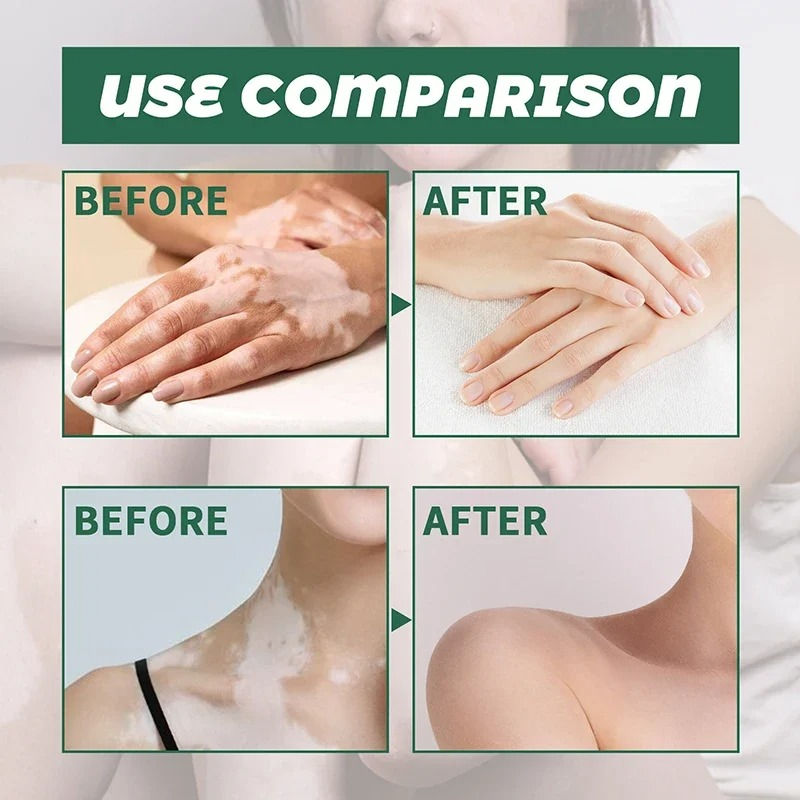 Thumbnail: Treatment of Vitiligo Psoriasis with 311 Nm Narrow-Band Ultraviolet Light by UVB