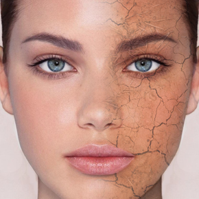 Dry Skin