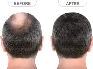 Back view of male head before and after hair extensions