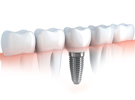 Implant8.jpg