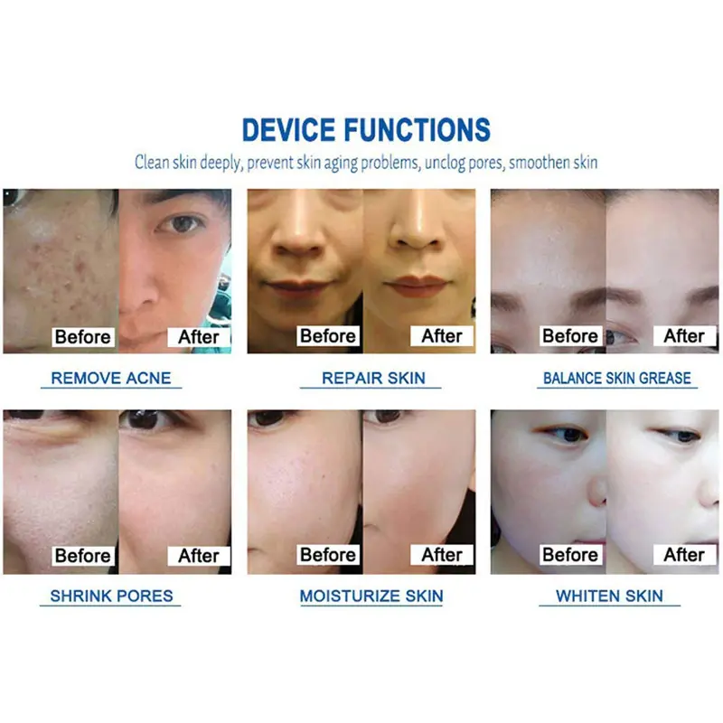 Miniatura: Hidrofacial 7 en 1 Aqua Peel