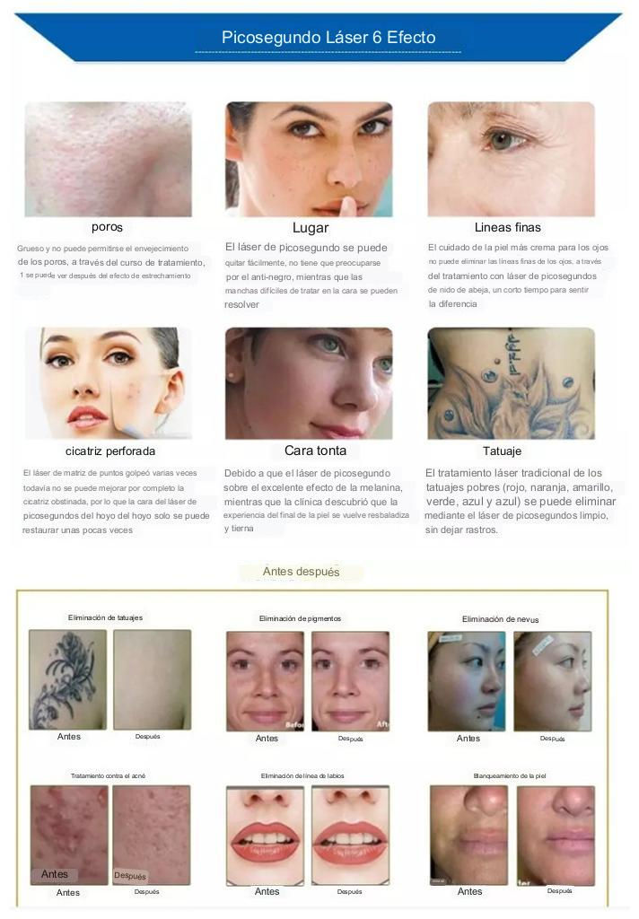 Miniatura: Laser Tridiodo Tipo ZP ice 360 + Picolaser No Invasivo