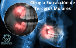 Terceros Molares