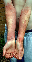 Giant hogweed - Heracleum mantegazzianum UV burns and blisters