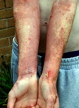 Giant hogweed - Heracleum mantegazzianum UV burns and blisters