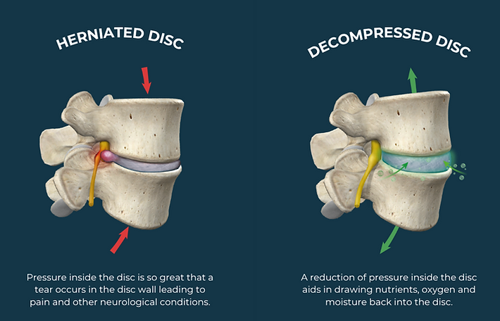 Disc decompression pic.png
