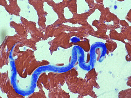 У 24-річної львів’янки з-під шкіри біля ока витягнули 14-сантиметрового гельмінта