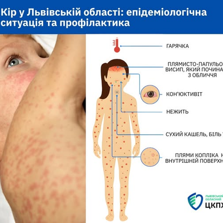 Кір у Львівській області: епідеміологічна ситуація та профілактика