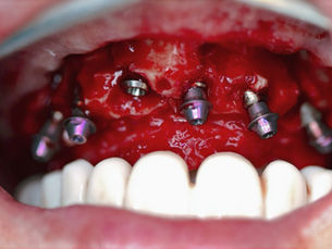Bimaxillary Immediate Loading: When Planning Meets Clinical Reality