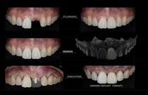 Is it fair to ask for a Metal-Free Implantology ?