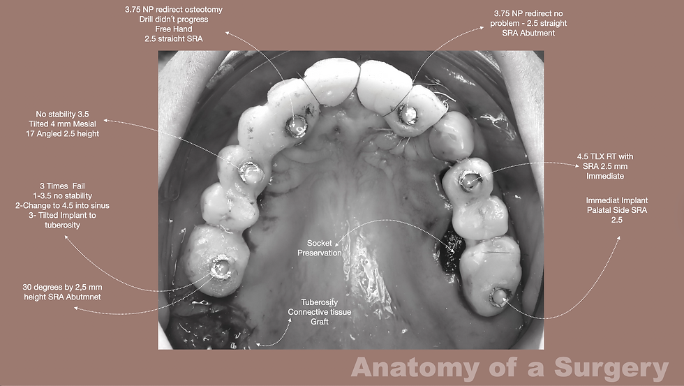 Occlusal surgical overview illustrating the intraoperative decision-making process during full-arch implant placement. Implant sites required multiple adjustments, including redirected osteotomies, freehand corrections, and changes in implant diameter for primary stability. Posterior regions demonstrate the biomechanical challenge of sinus proximity, tilted implant positioning, and tuberosity engagement. Straight and angled SRA abutments were selected according to implant trajectory and prosthetic requirements. This “anatomy of a surgery” highlights how real-time anatomical limitations influence guided protocols and final implant distribution.