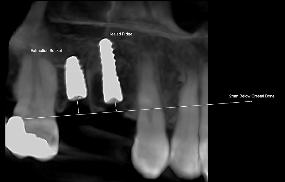 CBCT imaging confirms the parallel positioning of tooth #14 relative to the canine tip, highlighting the healed ridge and extraction socket 2mm below the crestal bone.