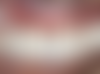 Beyond the Guide: Real-Life Challenges in Full-Arch Surgery