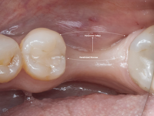 When the Ridge is a Knife Edge… and We Still Achieve a Perfect Implant