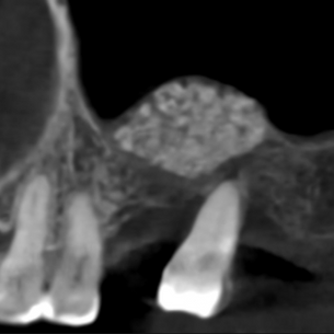 🌱 Spring, mistakes, and redemption — an implant that insisted on teaching