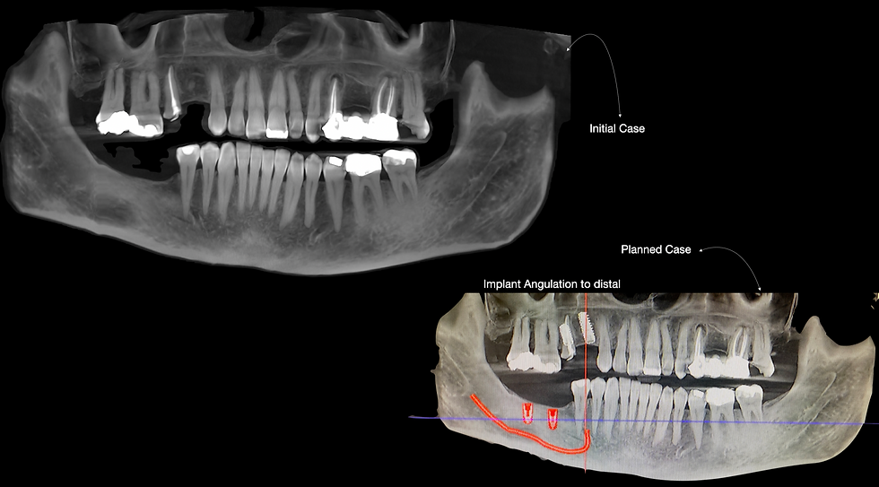 CBCT planning illustrating the distal angulation of implants 24 and 25 to strategically avoid the canine root tip.