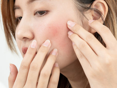 Understanding Rosacea: Causes, Symptoms, and Treatment Options