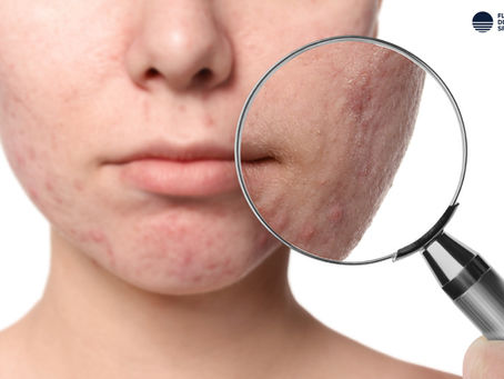 Improve Your Acne With Effective, Age-Appropriate Treatment Options