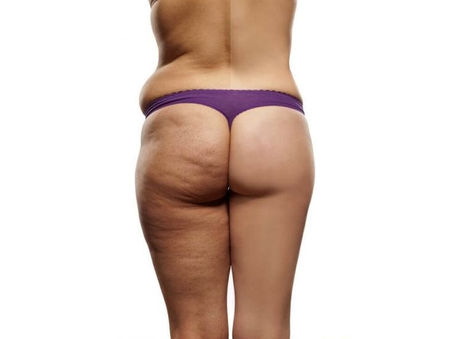 Sconfiggere la Cellulite: Un Approccio Scientifico per un Corpo Sano e Tonico