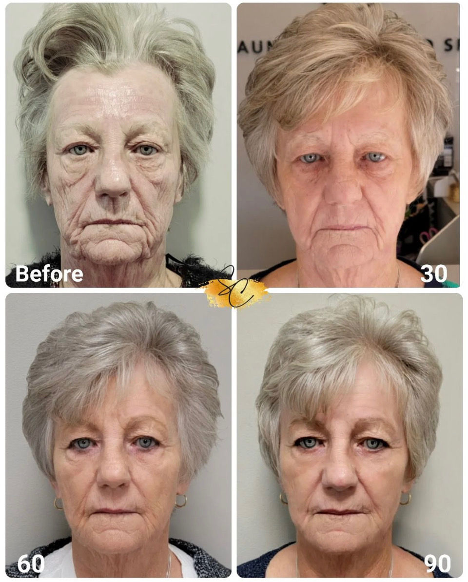 NeoGen PSR facial skin rejuvenation progression before treatment and at 30, 60, and 90 days