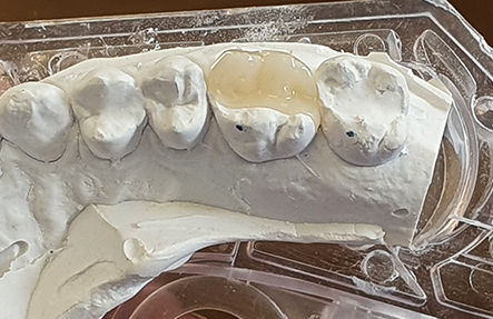 dara-king-kingdent-ltd-vaneers