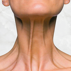 Tratamiento de bandas platismales del cuello con toxina botulínica en Dermony Providencia