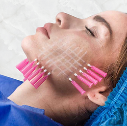 Bioestimulación facial con hilos lisos de PDO en Dermony Providencia