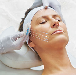 Lifting facial con hilos de tracción PDO para reposicionamiento de tejidos en Dermony Providencia