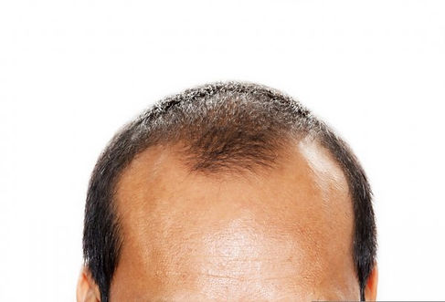 male baldness.jpeg