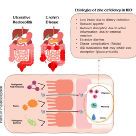Deficiências de Micronutrientes na Doença Inflamatória Intestinal: Uma Realidade Subestimada