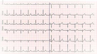 Imagem de ECG normal