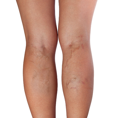 Microsclerotherapy