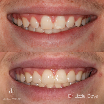 Composite Bonding of Six Front Teeth Before and After